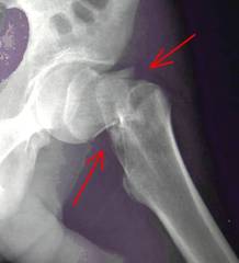 Anziani di Trani, cautelatevi: se vi fratturaste il femore, l'unico ospedale per operarvi è Canosa