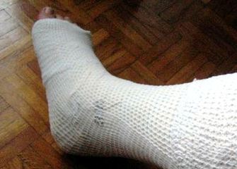 Si ruppe la gamba tornando a casa: dopo nove anni, 1300 euro a dipendente del Comune di Trani «per causa di servizio»