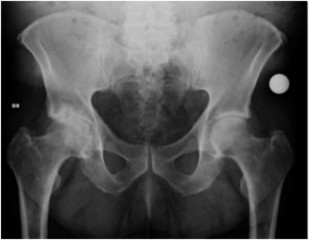 È paziente oncologica, ma le prenotano una radiografia a Trani il 30 giugno 2017: la farà stamani, a pagamento